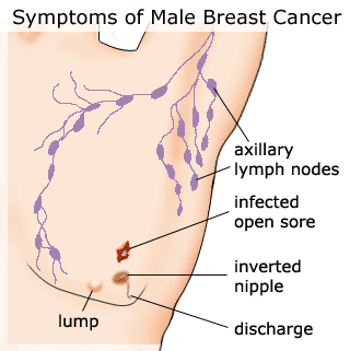 cancer breast